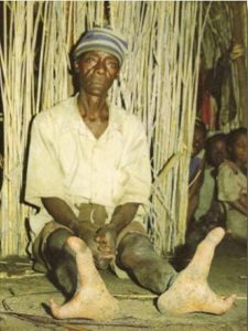 "Pies de avestruz", la extraña malformación con la que vive una tribu africana