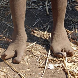"Pies de avestruz", la extraña malformación con la que vive una tribu africana
