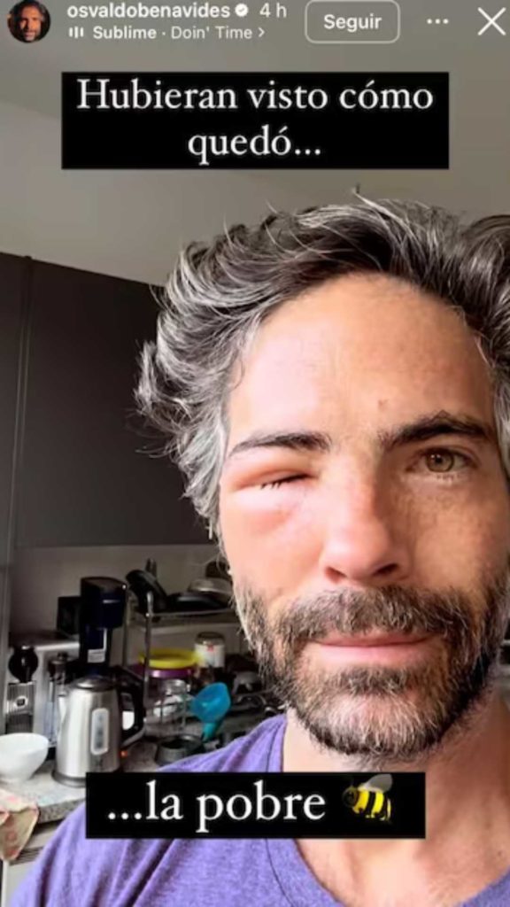 Osvaldo Benavides sorprende con rostro desfigurado y desata alarma en redes