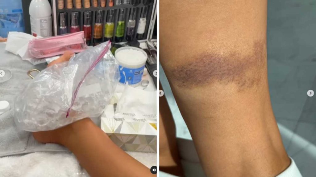 Thalía sufre aparatoso accidente y muestra los moretones que le quedaron